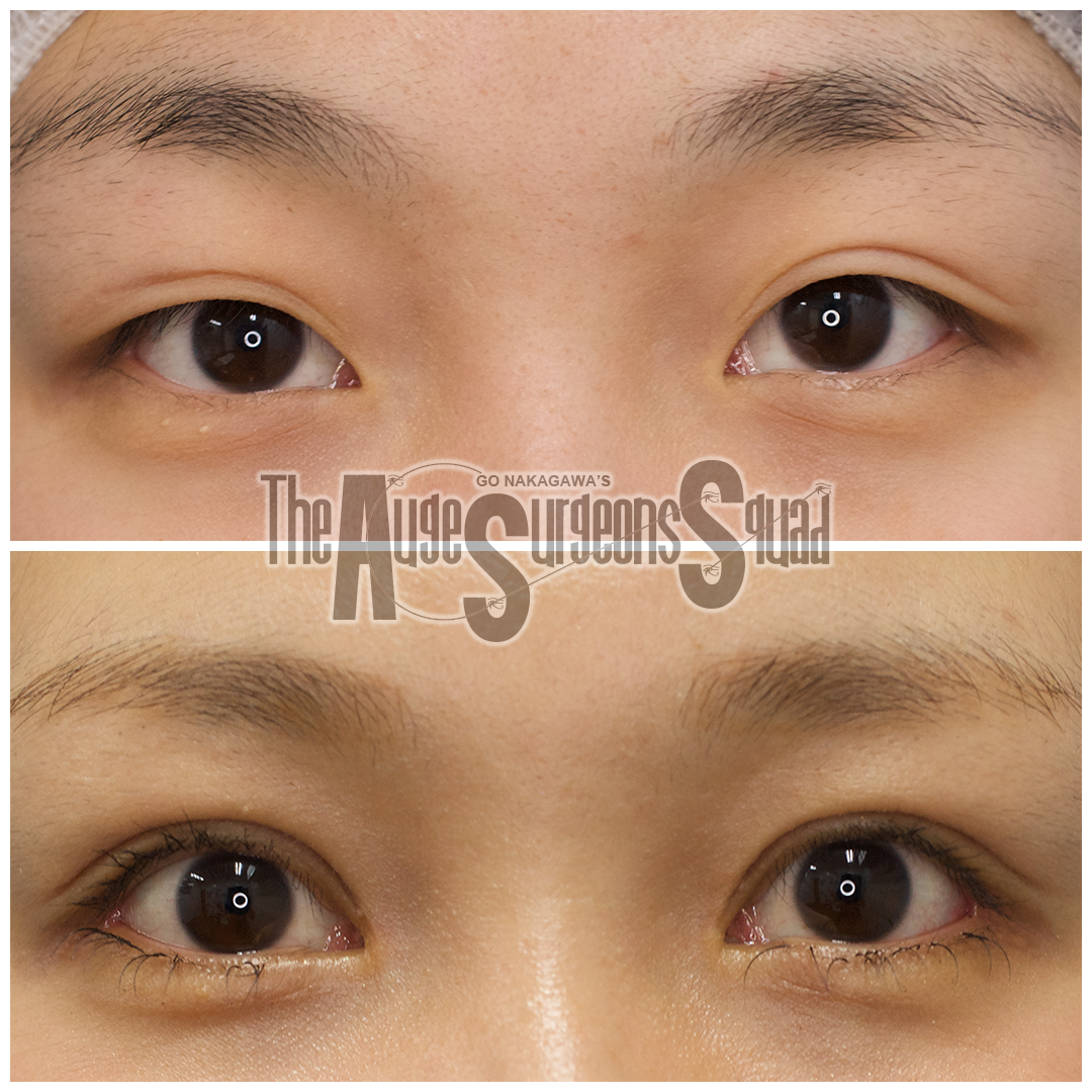 眼瞼下垂などの術前後